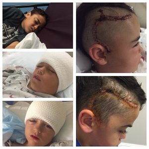 10-year-old Jaden pictured before and after receiving emergency surgery after falling off his bicycle. He was not wearing a helmet.